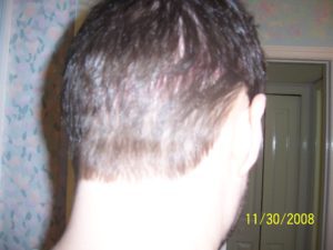 Large scar all along back of head gone.