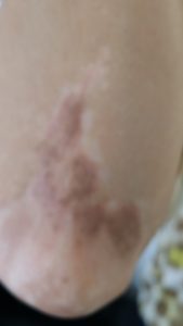 This is vilitago camoflague from a local permanent cosmetic artist that didn't have a clue how to do this work right. Now this poor client has to spend a lot of money lifting this with a tattoo removal laser and start over with a truly highly trained camouflage expert