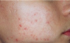This is a acne client after one treatment with Karen Marlise
