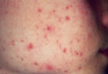This is a standard young person with acne.