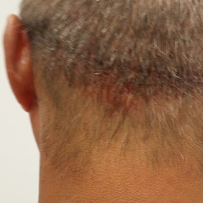 hair transplant scar just finished getting rid of with three colors and countless hairs created.