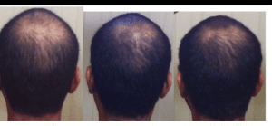 Hair Regrowth Treatment No More Bald Spot