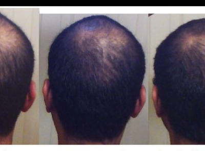 Hair Transplant Scar Camouflage and hair reputation for balding