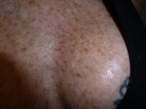  Chest with pigmentation problems for years of sun damage.