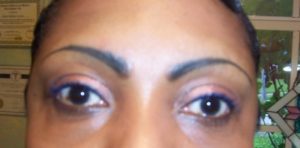 Keloid Scarring, Brows put on wrong