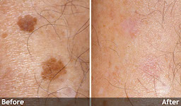 Laser Photo Rejuvenation - Before and After