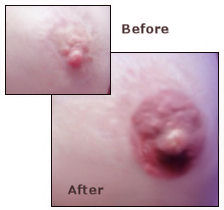 Nipple Reconstruction, nipple pigmentation, areola tattooing